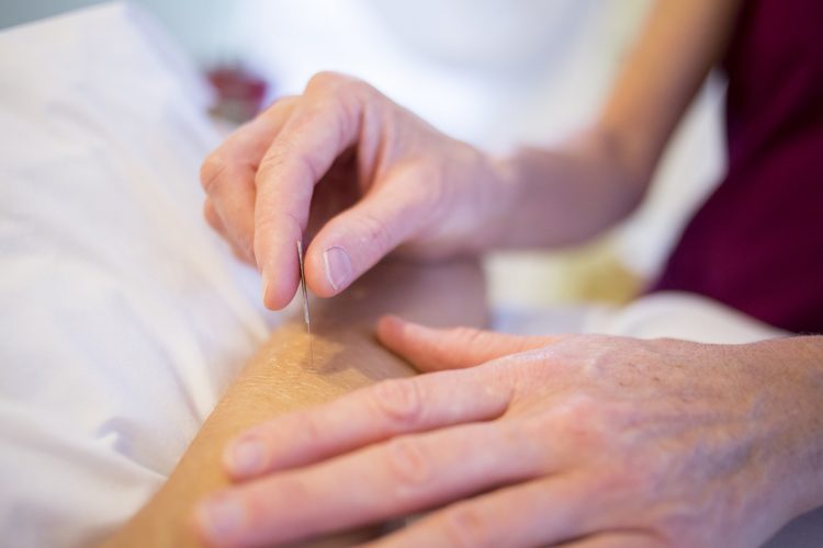 Accupuncture